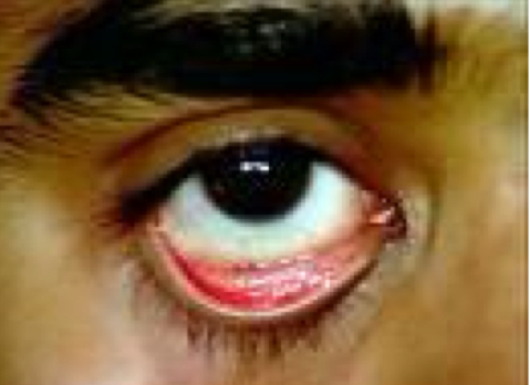 <p>The epithelium covering the inner surface of the eyelid, cover the anterior surface of the eye, and extend to the edge of the cornea. The conjunctiva keeps bacteria and foreign material from getting behind the eye</p>