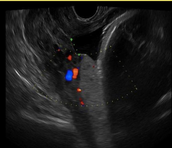 <p>which type of placenta previa is defined as placement of the placental tip <strong>within 2cm</strong> of crossing the <strong>internal os</strong></p><p>.</p><p>a) partial previa</p><p>b) low lying placenta</p><p>c) velamentous previa</p><p>d) vasa previa</p>