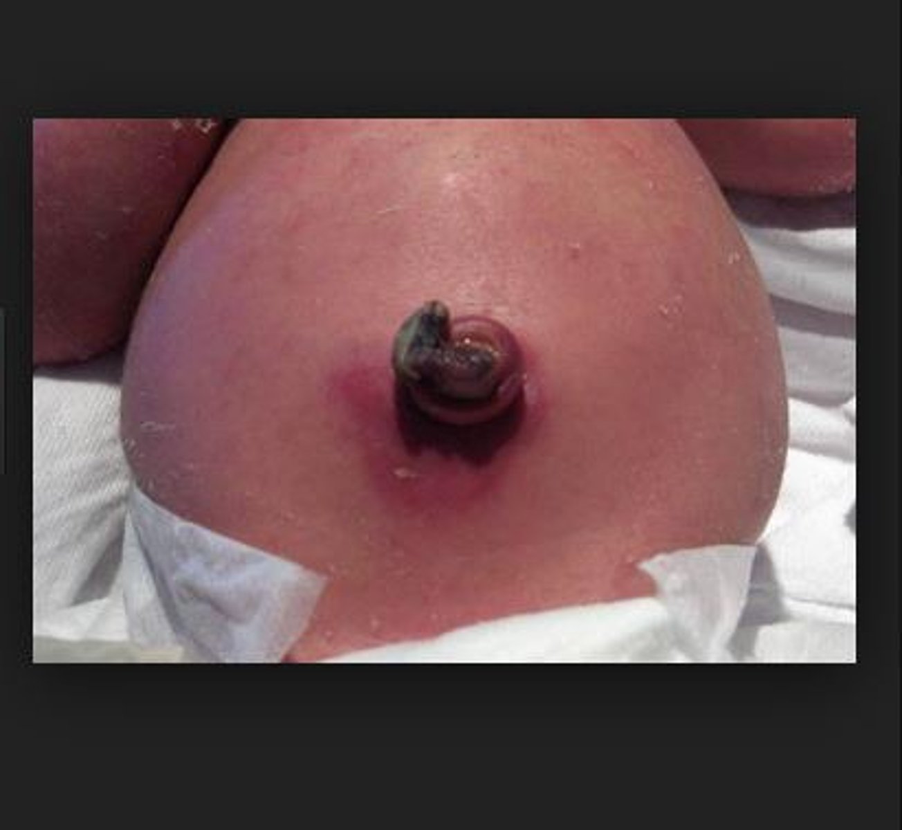 <p>inflammation of the umbilicus</p>