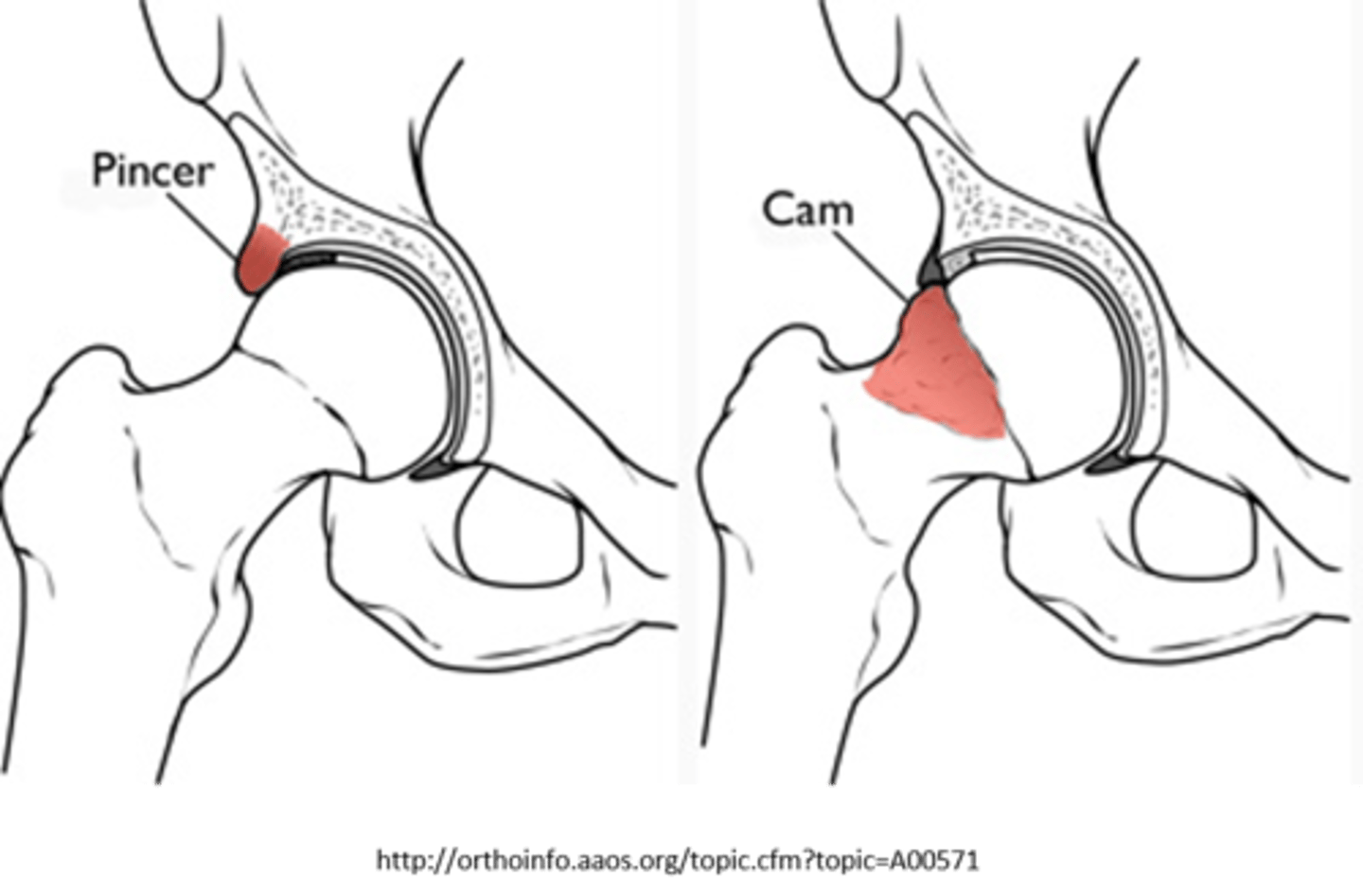 <p>femoroacetabular impingement<br>- cam: outgrowth on femoral head<br>- pincer: outgrowth on acetabulum</p>