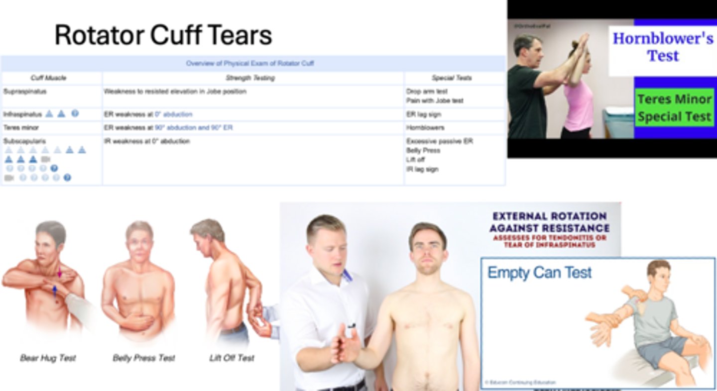 <p>- +/- Limited active ROM, passive ROM is generally full</p><p>- +/- Neer and Hawkins impingement signs</p><p>Mainstay of PE -- special tests to evaluate each rotator cuff tendon:</p><p>- Drop arm test (inability to hold the arm in an abducted position against gravity) indicates large rotator cuff tear</p><p>- Positive Empty can or Jobe test (weakness with resisted abduction) indicates supraspinatus tear</p><p>- Weakness with resisted external rotation indicates infraspinatus tear</p><p>- Positive lift-off or belly press test indicates subscapularis tear</p>