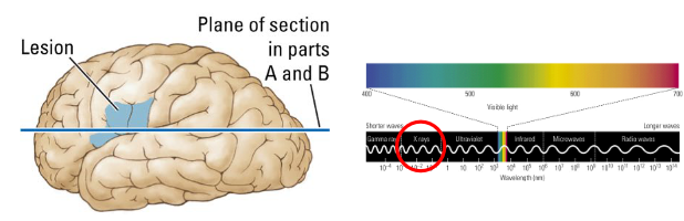 <ul><li><p>High-density tissue (e.g. bone) absorbs a lot of radiation → light regions.</p></li><li><p>Low-density tissue (e.g. CSF, blood) absorbs little radiation → darker regions.</p></li><li><p>Neural tissue absorption lies in-between.</p></li></ul><p></p>