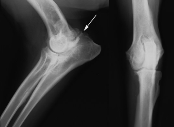 <ul><li><p><strong>Cause</strong></p><ul><li><p><strong>Anconeal </strong>process forms from a <strong>separate center of ossifications</strong></p><ul><li><p>unfused</p></li></ul></li><li><p><strong>Young Lg dogs</strong></p><ul><li><p>GSD</p></li></ul></li></ul></li><li><p><strong>CS</strong></p><ul><li><p>weight bearing lameness</p></li></ul></li><li><p><strong>RS</strong></p><ul><li><p>Irregular<strong> radiolucent line cross</strong> the anconeal process</p></li></ul></li></ul><p></p>