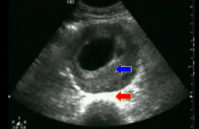 <p>Disregarding the arrows, what pathology is seen here? </p>