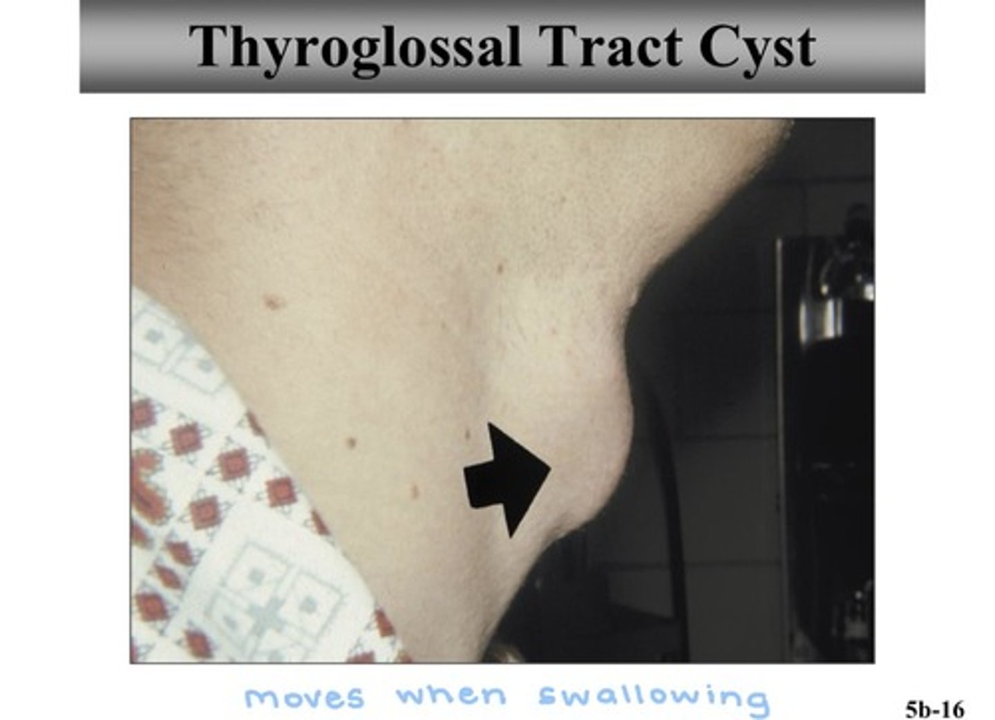 <p>- cause: epithelial remains trapped during thyroid gland development</p><p>- population: young adults (under 20)</p><p>- clinical features: dysphagia or difficulty extending tongue ; firm swelling at midline of neck, moves when swallowing</p><p>- radiographic features: none</p><p>- treatment: surgical excision along entire tract (part of hyoid bone + mm)</p>