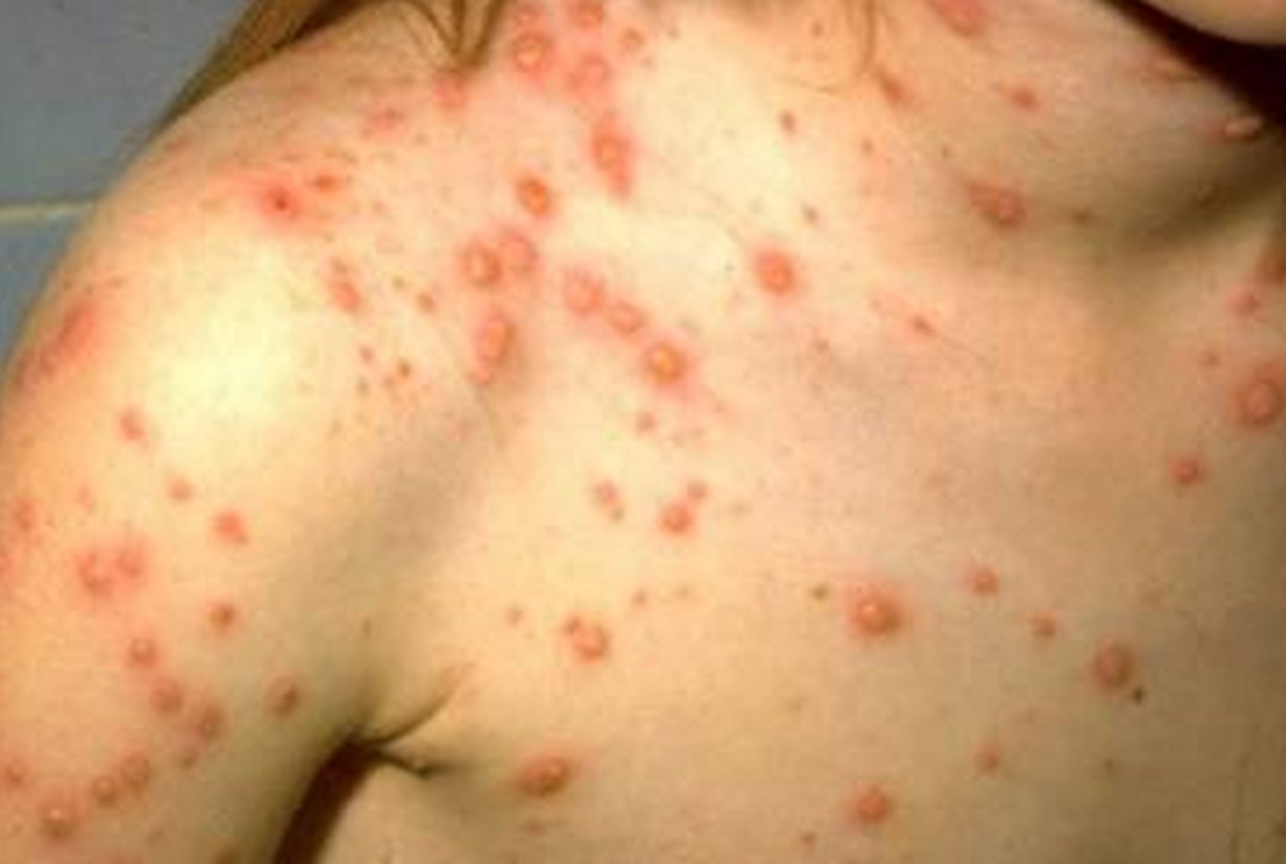 <p>Pruritic vesicles on erythematous base (“dewdrop on rose petal”) in crops, starts on trunk, in various stages of healing</p>