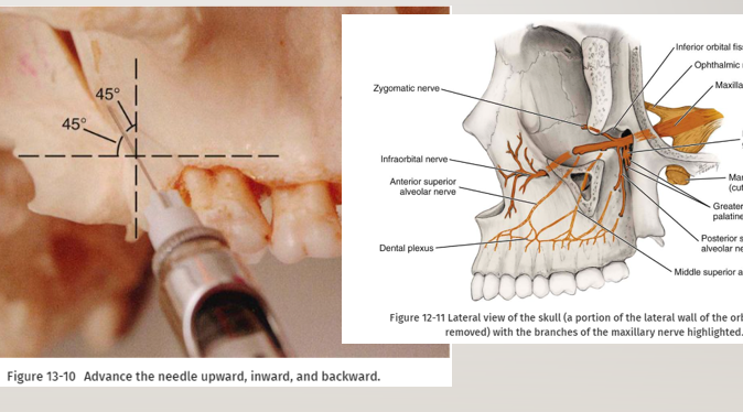 <p>-assume correct position: for left PSA nerve block- sit at the 10 o’clock position facing the patient, for right PSA block- sit at 8 o’clock position facing the patient</p><p>-prepare the tissues at the height of the mucobuccal fold for penetration: dry with sterile gauze, apply a topical antiseptic (optional), apply topical anesthetic for a minimum of 1 minute</p><p>-orient the bevel of the needle toward bone</p><p>-partially open the patient’s mouth, pulling the mandible to the side of injection</p><p>-retract the pt’s cheek with instrument (for visibility)</p><p>-pull the tissues at the injection site taut</p><p>-insert the needle into the height of the mucobuccal fold over the second molar</p><p>-advance the needle slowly in an upward, inward, and backward direction in one movement</p><p>-slowly advance the needle through soft tissue- should be no resistance and no discomfort to pt, if resistance is felt the angle of the needle in toward the midline is too great (withdraw the needle slightly and bring the syringe barrel closer to the occlusal plane, readvance needle)</p><p>-advance needle to desired depth: adult- 16mm (1/2 of short needle), 10-14mm for smaller adults and children</p><p>-aspirate in 2 planes</p><p>-if both aspirations negative: slowly deposit 0.9-1.8mL of anesthetic solution over 30-60 seconds, aspirate several additional times during drug administration</p><p>-slowly withdraw syringe</p><p>-make the needle safe</p><p>-wait minimum of 3-5min before commencing the dental procedure</p>