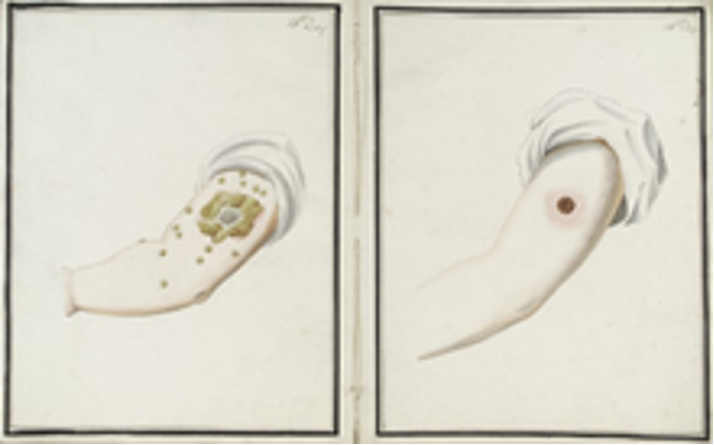 <p>Jenner’s vaccines method</p>