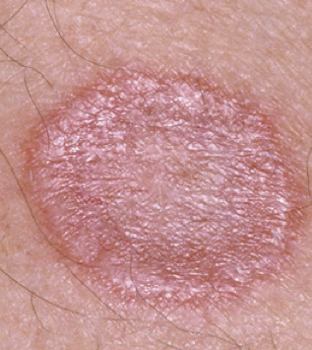 <p>Ring-like with central clearing</p>