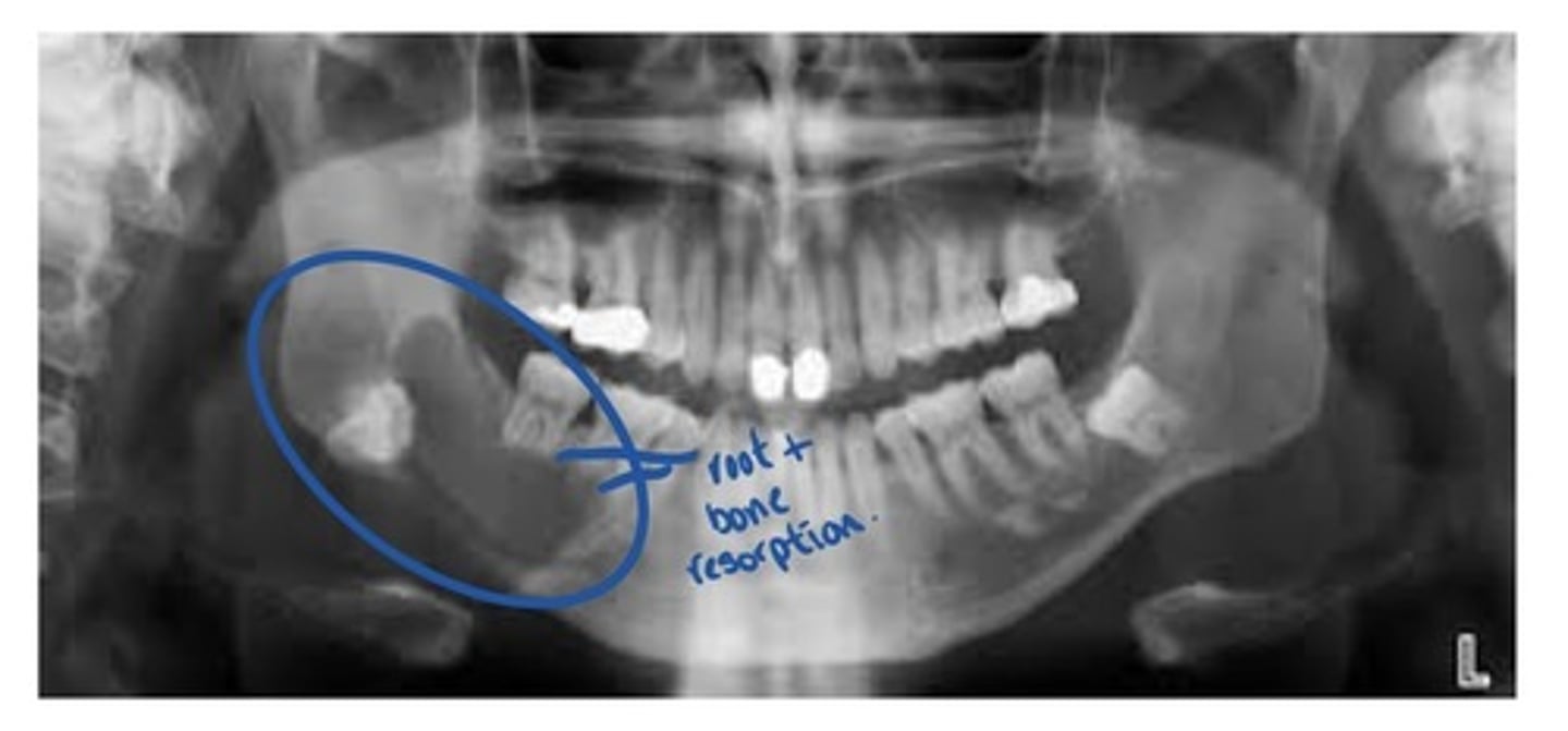 <p>This is a common type of cyst that forms around the crown of an unerputed or developing tooth. The epithelial lining originates from the reduced enamel epithelium (REE) after the crown has formed and calcified. Most commonly occurs around the crown of an unerupted or impacted third molar.</p><p>Radiographically: a well-defined, unilocular radiolucency around the crown of an unerupted or impacted tooth.</p><p>Treatment: removal of the cyst as there is some risk of cystic transformation into a neoplasm.</p>