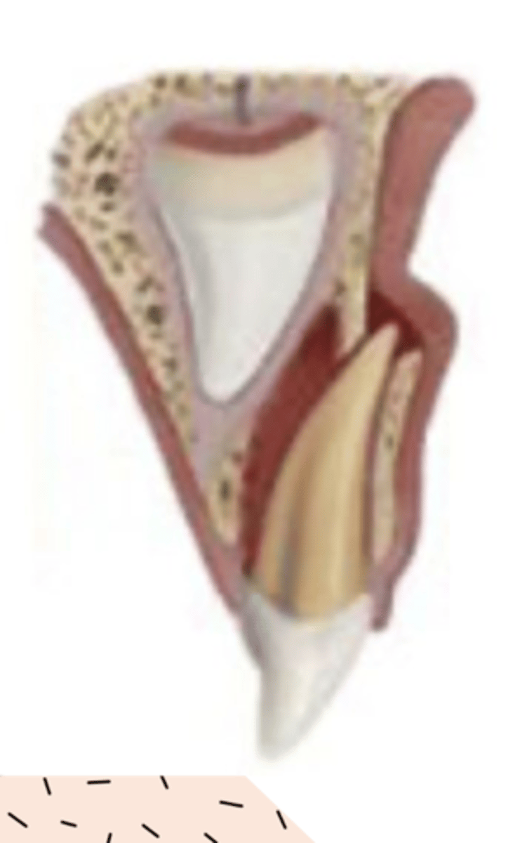 <p>e. Lateral luxation</p>