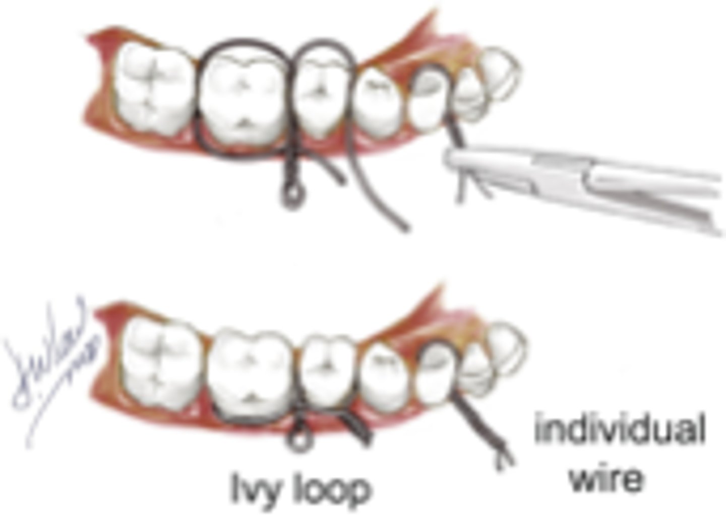 <p>ID the closed treatment/ maxillomandibular fixation:</p><p>•Appropriate when few teeth are present</p><p>•Typically used for limited fixation period</p>
