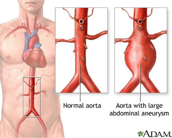 <p>Aortic Aneurysm</p>