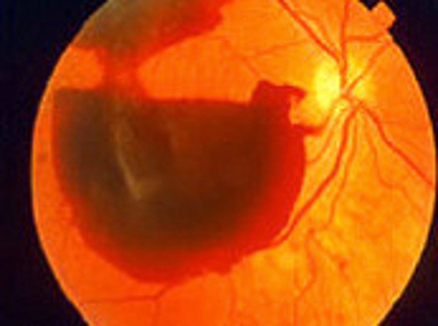 <p>Vitreous hemorrhage</p>