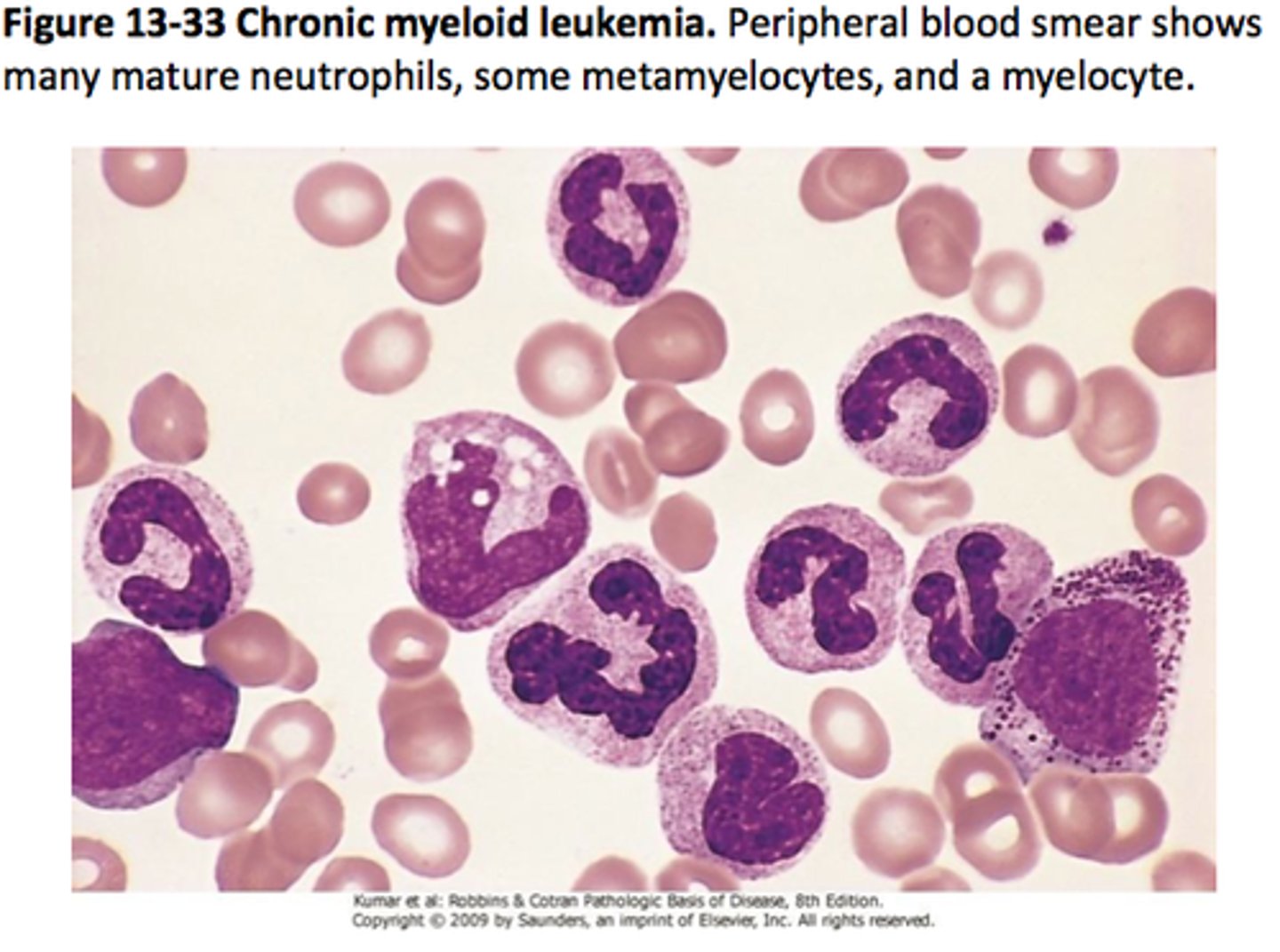 <p>Low =possibly CML<br>High = prolly leukemoid reaction</p>