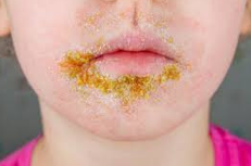 <ul><li><p><strong>Bacterial Infection:</strong></p><ul><li><p>Epidermal, contagious</p></li><li><p>Papules progressing to vesicles, then painless pustules with a narrow erythematous border.</p></li><li><p><strong>Honey-colored crusting/exudate</strong> when the vesicles or pustules rupture.</p></li><li><p><strong>Cause:</strong> <em>Staphylococcus</em> or <em>Streptococcus</em> getting under the skin.</p></li></ul></li><li><p><strong>Most Common Sites:</strong></p><ul><li><p>Face</p></li><li><p>Mouth</p></li><li><p>Hands</p></li></ul></li><li><p><strong>Nursing Care:</strong></p><ul><li><p>Removal of crust (wound care)</p></li><li><p>Antibiotics (oral or topical)</p></li><li><p>Hygiene (just keep it clean!)</p><p></p></li></ul></li></ul><p></p>