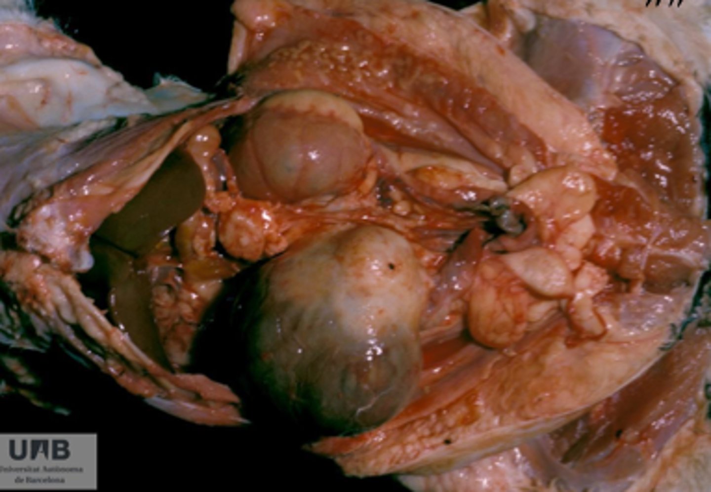 <p>tumor of the kidney</p>