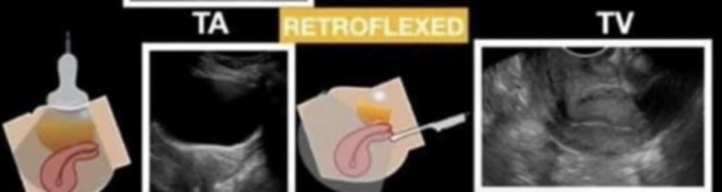 <p>fundus and body bent posteriorly</p>