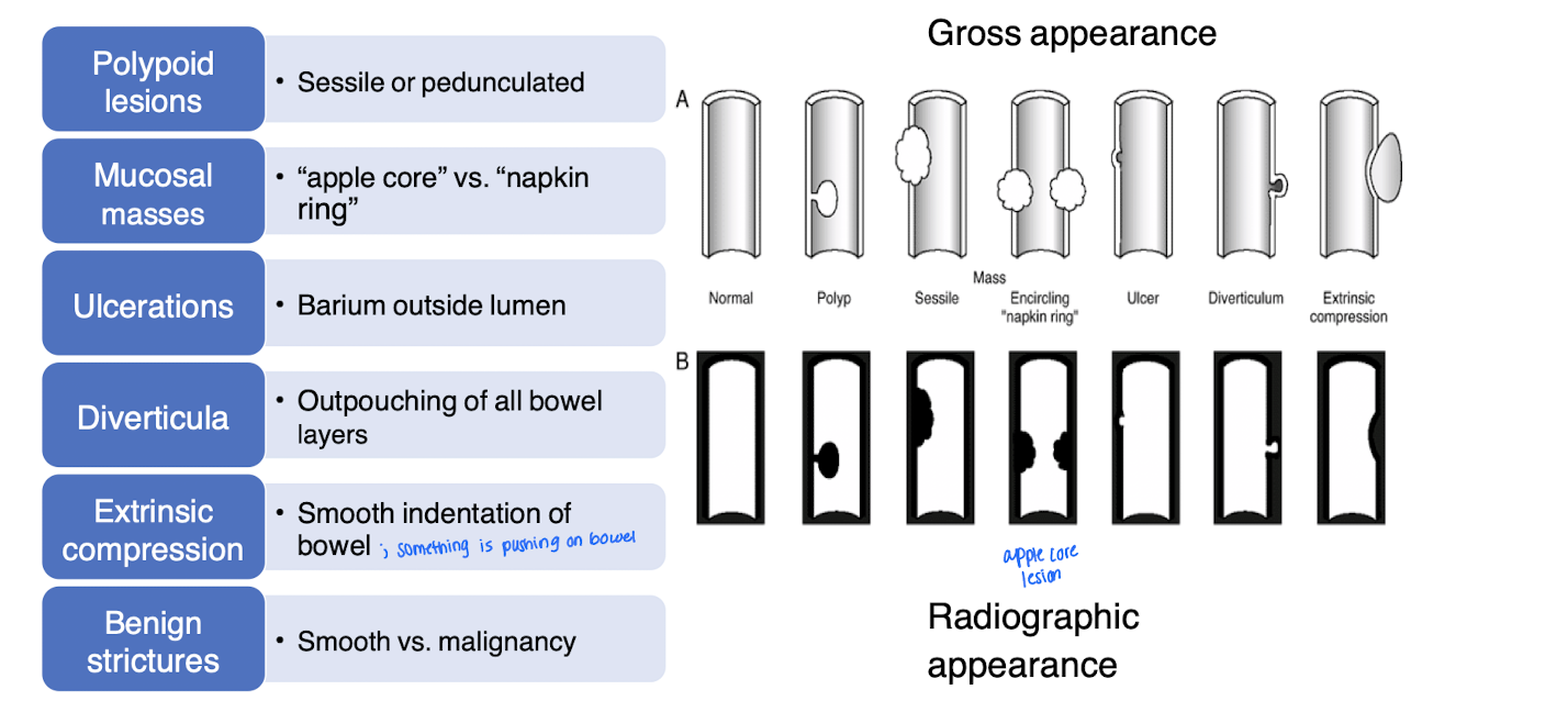 <p>Extrinsic compression</p>