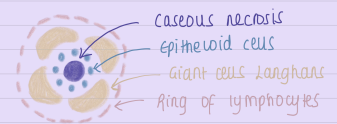 <ul><li><p>TB has caseous granuloma but sarcoidosis has non-caseous granuloma.</p></li></ul><ul><li><p>Sarcoidosis has a small amount of lymphocytes and giant cells with no necrosis.</p></li></ul><p></p>