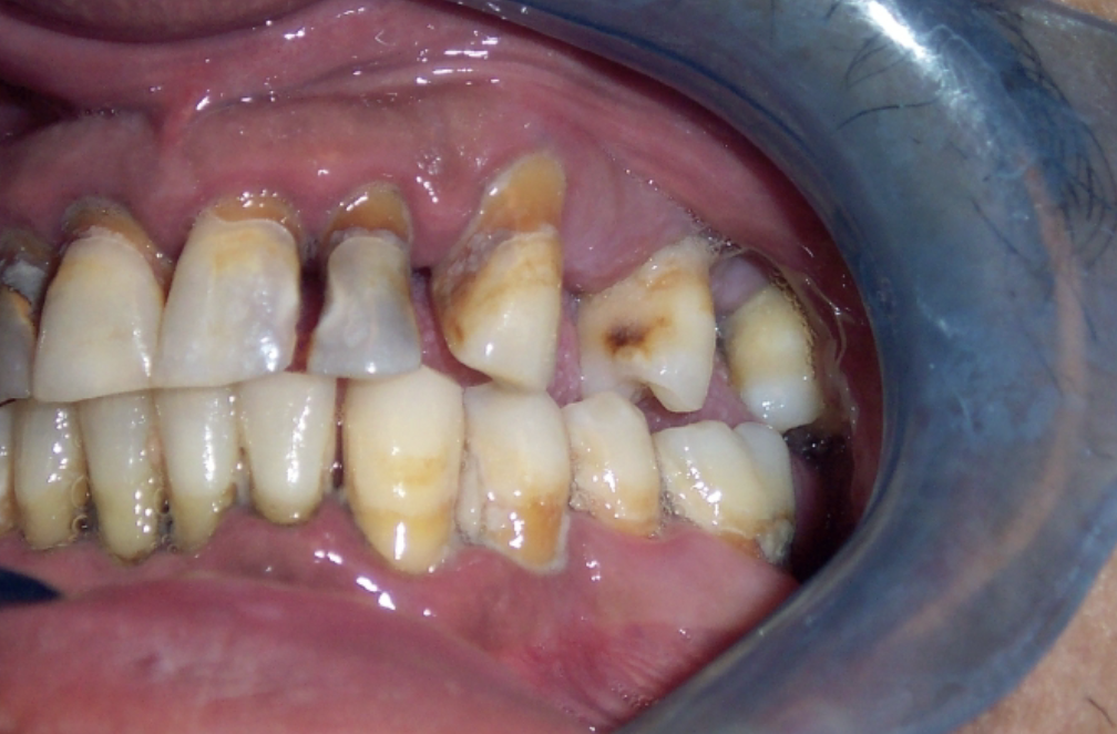 <p>Exogenous Intrinsic Stains: Other Local Causes </p>
