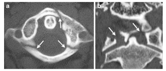 <p>What is the fracture seen in the image below and how is it caused? </p>