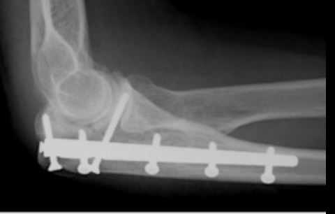 <p><strong><u>small incision and a lower rate of infection</u></strong>, but can only<strong><u> be used in the shaft or midline </u></strong>of the bone and<strong><u> only or certain fracture shapes</u></strong></p>