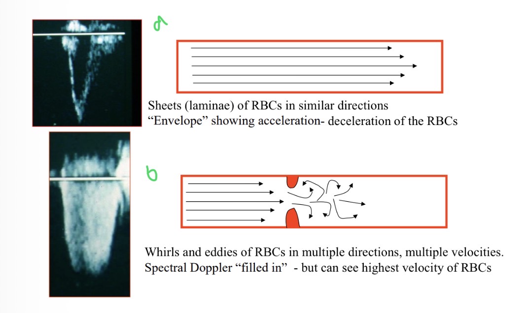 <p>When is turbulent flow seen </p>