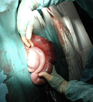 <p>intraluminal hemorrhage, usually in the jejunum, with subsequent bowel obstruction</p>