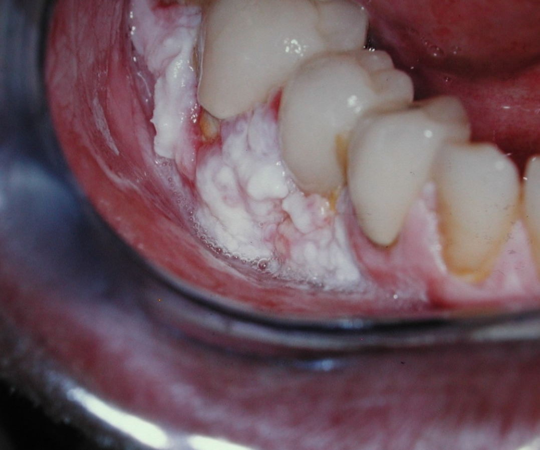 <p>6b. Why is PVL concerning?</p>