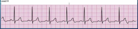 Ex. 7 QRS complexes x 10 = 70 BPM (6 second trip)
