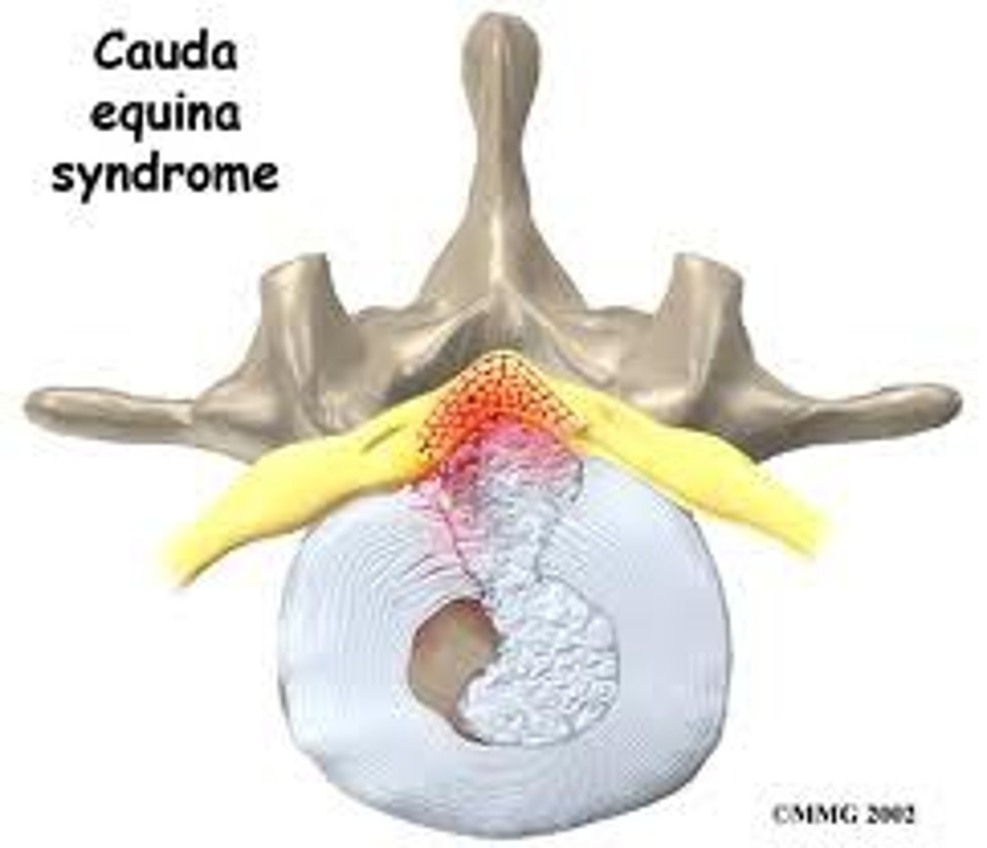 <p>- inability to rise from a chair</p><p>- gait disturbances</p><p>- poor anal sphincter tone and/or perineal numbness</p>