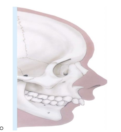 <ul><li><p><span style="background-color: transparent;">where the jaw is retrognathic</span></p><ul><li><p><span style="background-color: transparent;">Malocclusion</span></p></li><li><p><span style="background-color: transparent;">Skeletally and Dentally retrognathic ( overbite)</span></p></li><li><p><span style="background-color: transparent;">First molar relationship more distal; upper canine is more forward than lower</span></p></li></ul></li></ul><p></p>
