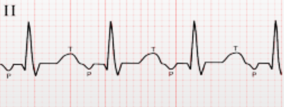 <p>Determine the atrial dysrhythmia:</p><p>Atrial rate is 120-250 bpm, regular unless there is a variable block at the AV node; P waves with different shapes, precedes each QRS complex but may be hidden in preceding T wave.</p>
