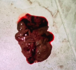 <p>vomiting is frequently the first clinical sign (hematemesis common) in 50% of cases&nbsp;</p><p>often norm/hypothermic at presentation</p>