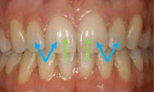 <p>which teeth does the mandibular central incisor <strong>occludes </strong>with?</p><p><strong>*unique: it only occludes with only one tooth</strong></p>