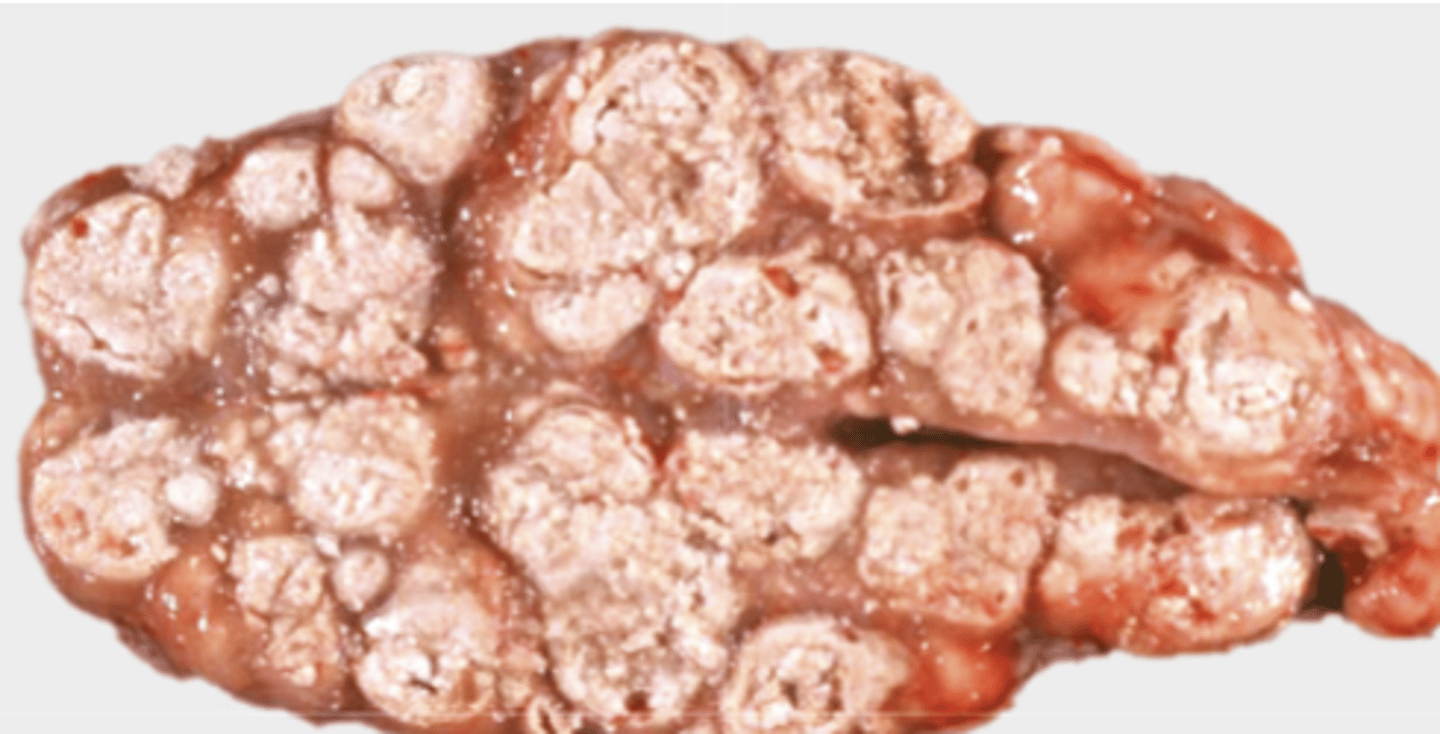 <p>What type of necrosis is being shown in this photo?</p>