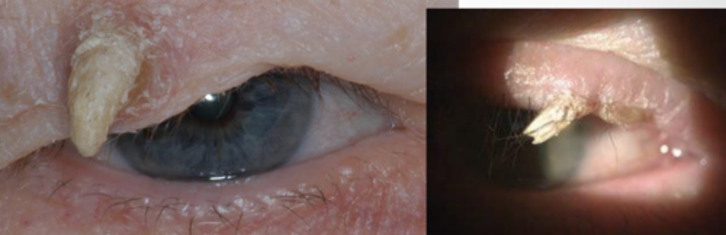 <p>somewhat non-specific descriptor of hyperkeratinized, elongated growth seen in verruca, seborrheic keratosis, basal cell and squamous cell carcinoma</p>