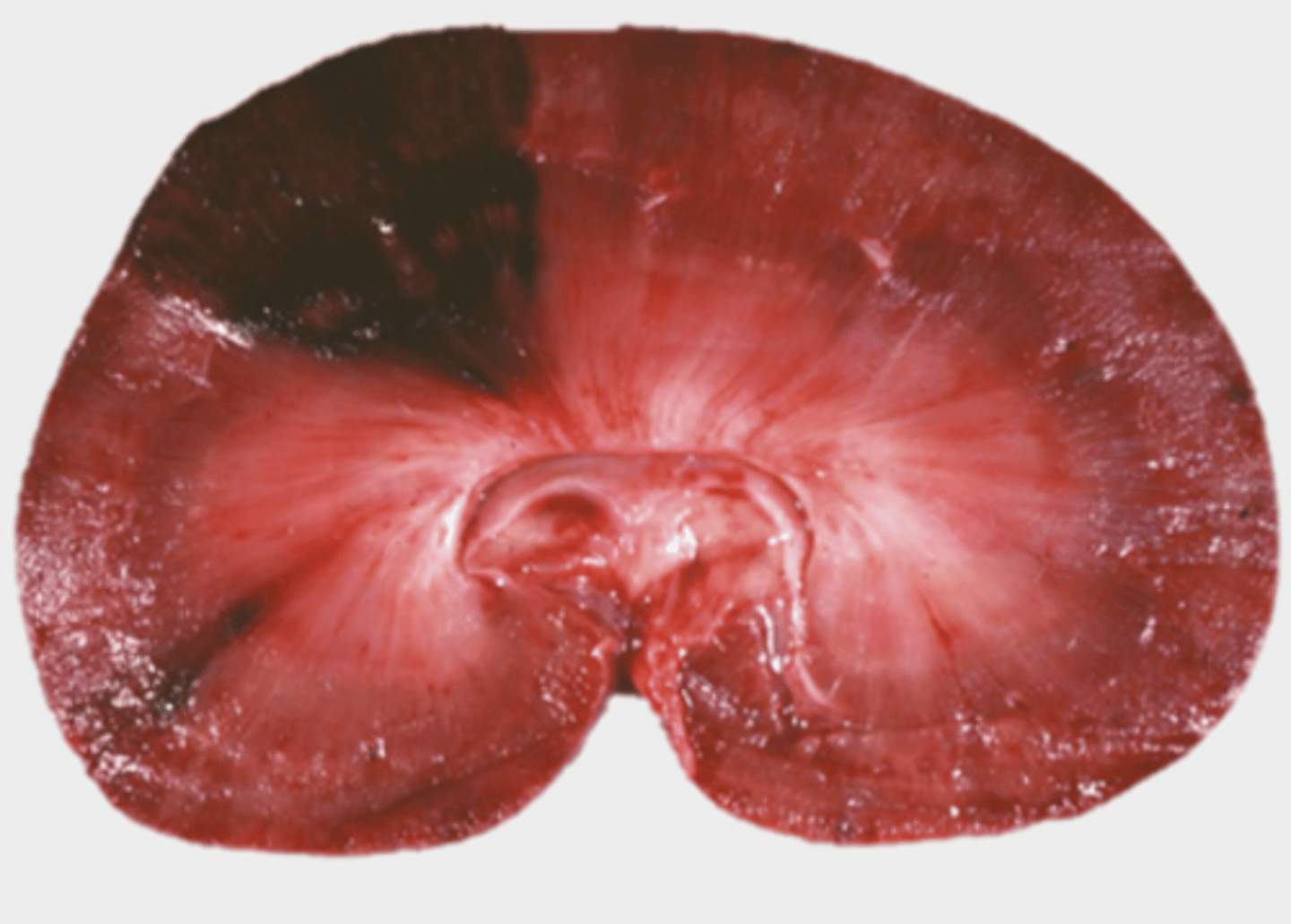 <p>What is the distrubution this hemorrhagic infarct?</p>