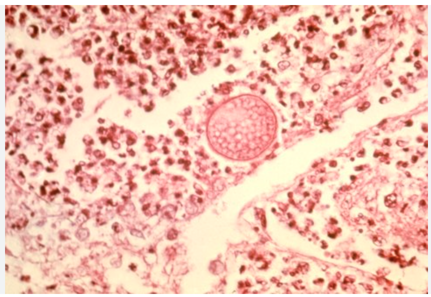 <p>Diagnosis of Valley fever</p>
