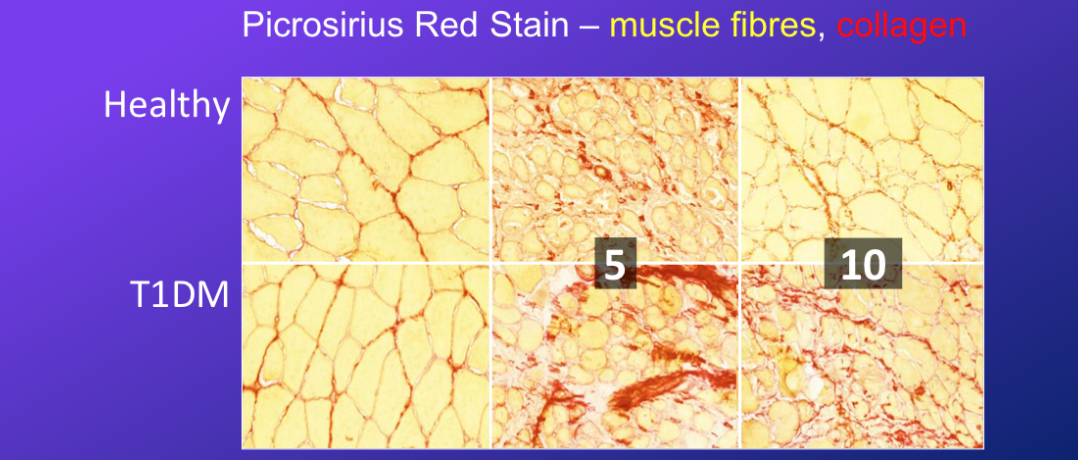 <p>-in T1 diabetes, muscle damage leads to an overabundance of collagen =&gt; then repeated damage/repair leads to muscle fibrosis (we already know they have inability to regenerate muscle to greater extend over its original state pre damage)</p><p>-there is a hardening/calcifying of the ECM, so makes it harder for agents to come in to these newly formed muscles to change them to desired state</p><ul><li><p>so in recobery, there is enhancement of collagen depositiona nd fibres dont return to original state</p></li></ul><p>-then lots of fat starts to accumulate in this area too because too much ECM deposition allows for fat to develop where muscle fibres ought to be (more common in T1D) =&gt; also leads to signalling inability for insulin in muscle</p><ul><li><p>bc also they dont return to as big after damage, so emptier space is filled w fat</p></li></ul><p>-summary: in T1D there is more ECM, so makes it harder for fibres to regenerate, also makes nerves moving to innervate these fibres more difficult to navigate</p>