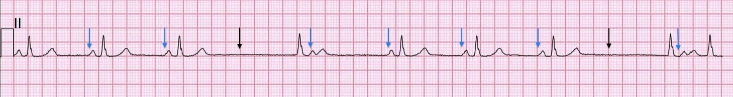 <ul><li><p>Intermittent P waves “drop out” of the rhythm, while subsequent P waves arrive “on time”.</p></li><li><p>distance from one p wave to the other is the same</p></li></ul><p></p>