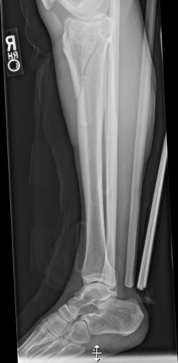 <p>long bone found in the leg extending from the knee to the ankle.</p>
