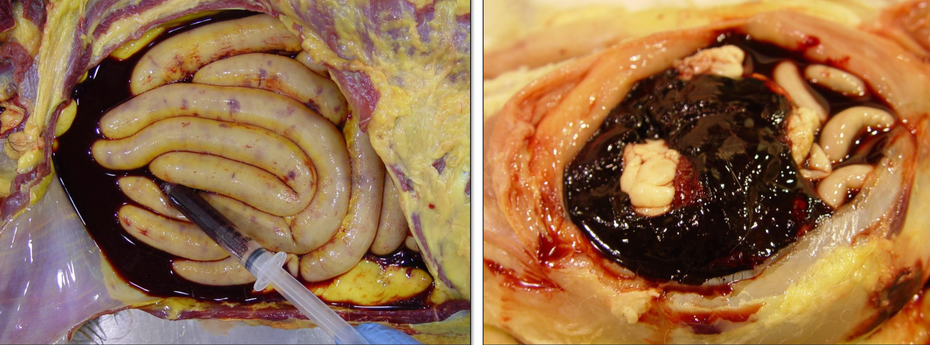 <p>Blood in the abdomen (peritoneal cavity)</p>