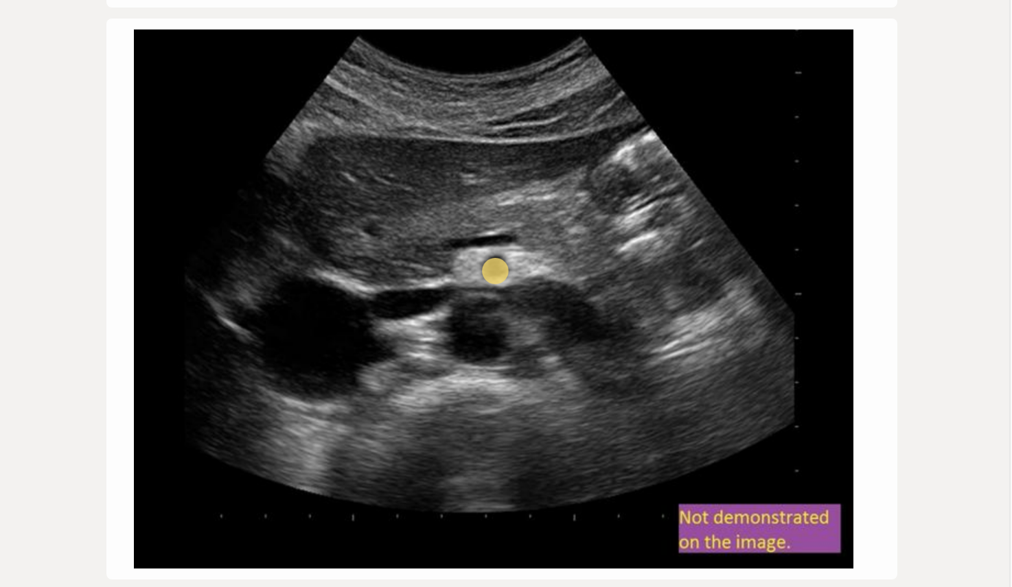 <p>anterior to left renal vein </p>