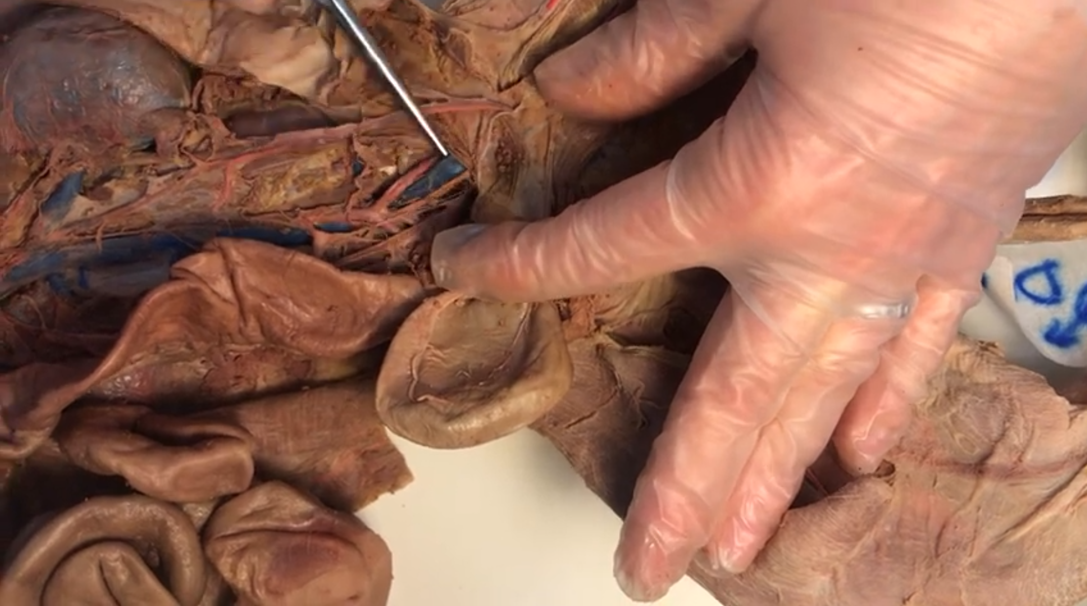 <p>What vein is this</p>