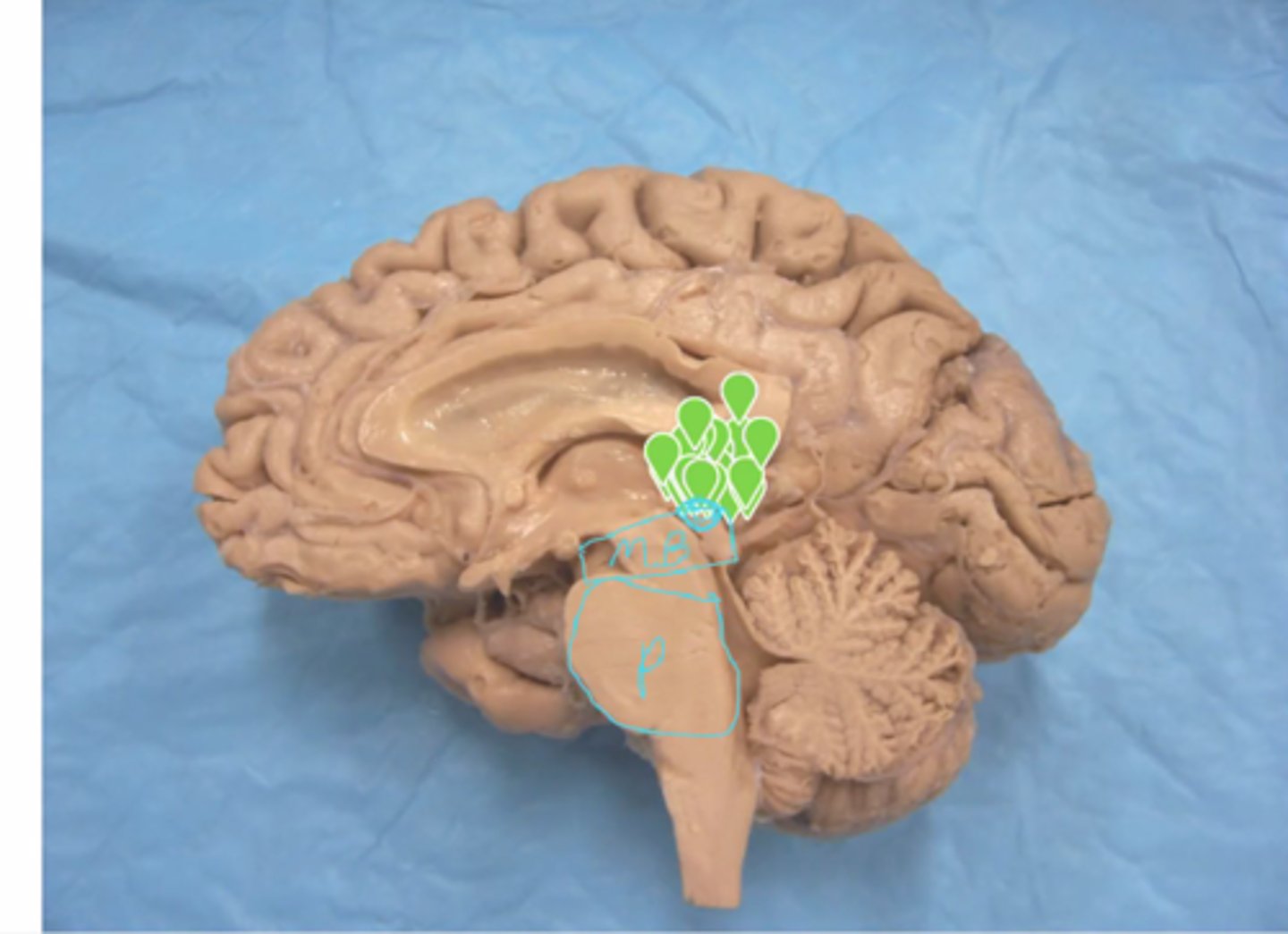 <p>Identify the structure labeled "MB"</p>