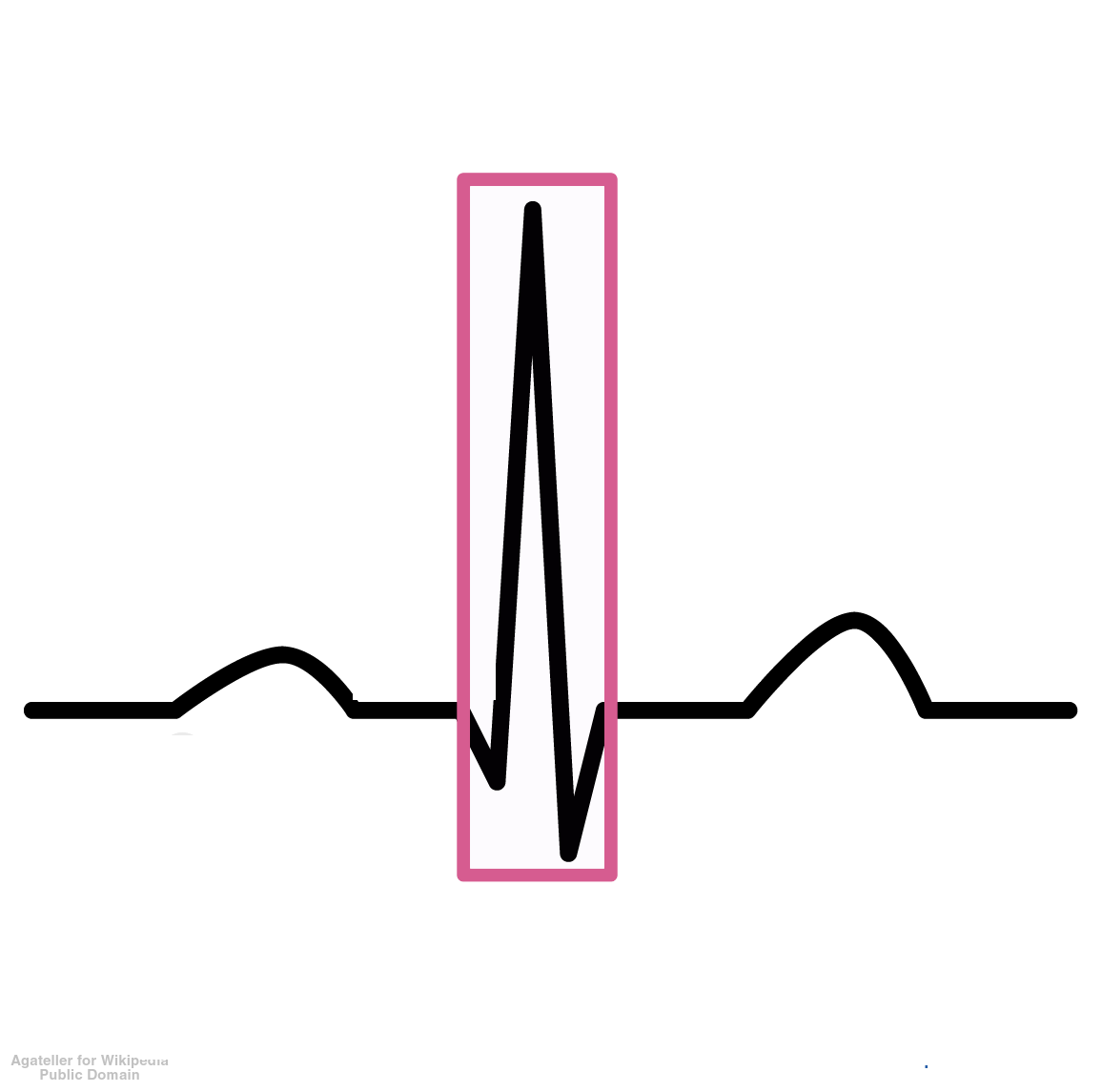<p>Represents ventricular depolarization; the sharp, jagged portion of the EKG wave.</p>