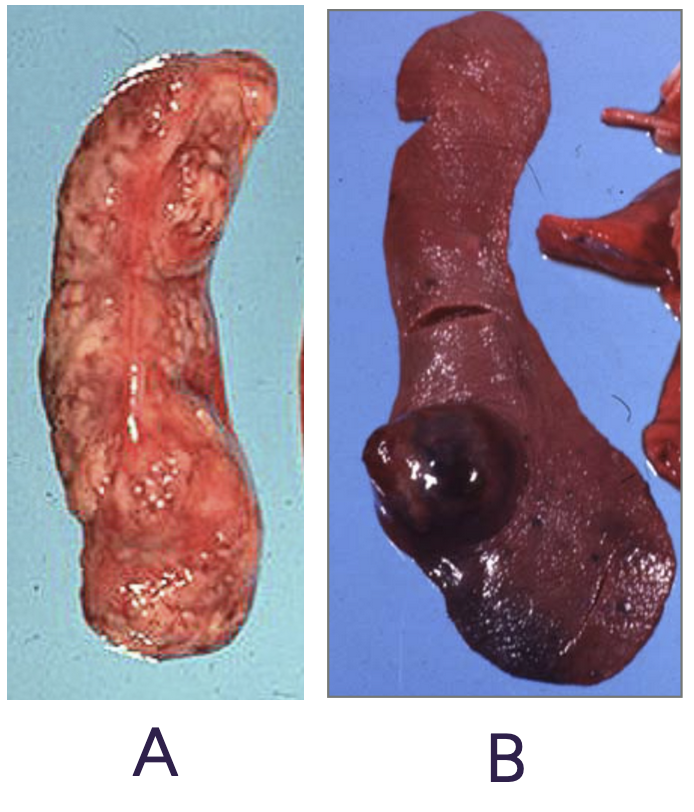 <p><span style="background-color: transparent;">Both of these masses on the spleen are very invasive.</span></p><p><span style="background-color: transparent;">What are the correct distributions of each lesion?&nbsp; +&nbsp; Identify if the mass is more likely to be hemangiosarcoma or lymphosarcoma?</span></p>