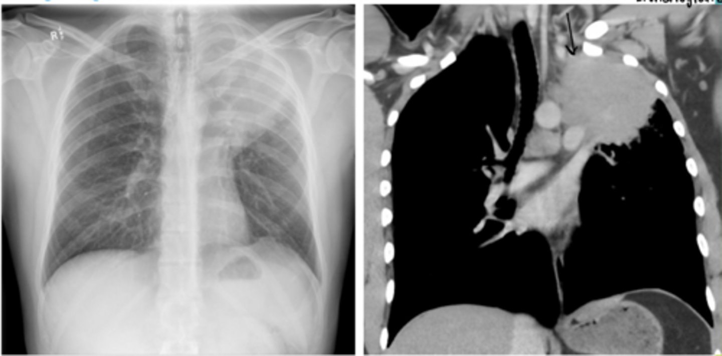 <p>A 24-year-old man presents with a 2-month history of painless swelling in his neck/lymphadenopathy. He reports increasing fatigue, intermittent fevers, and drenching night sweats. Over the past 3 months, he has unintentionally lost 12 pounds.</p><p>Physical examination reveals:</p><p>Enlarged, firm, non-tender cervical lymph nodes</p><p>No signs of infection</p><p>Mild pallor</p>